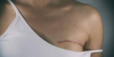 I'm Not Broken: Please Stop Kissing My Mastectomy Scars