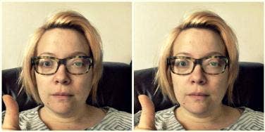 blonde woman in glasses with a shingles rash on her eye gives a wary thumbs-up
