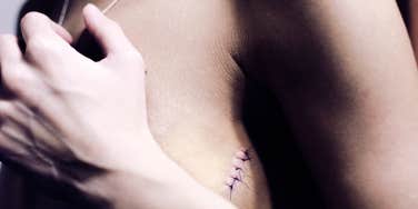 Woman showing her breast cancer scar