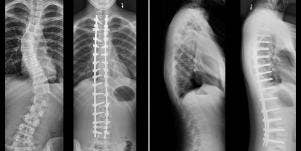 Author's Daughter Spinal X-Rays Before And After Fusion Surgery