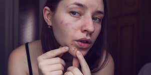 woman popping pimple around mouth
