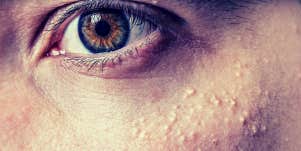 person with bumps under eyes