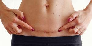 woman pointing at her c-section scar