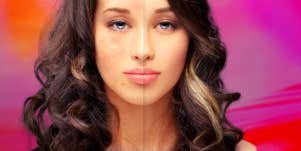 woman with acne scars