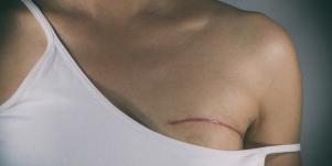 I'm Not Broken: Please Stop Kissing My Mastectomy Scars