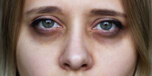 woman with dark circles